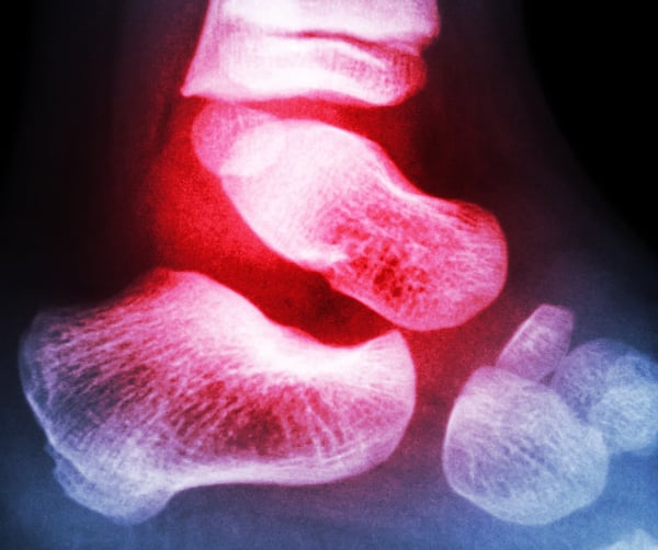 A scan of a foot shows some areas coloured red to mimic inflammation